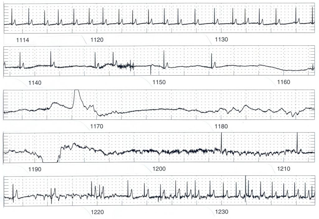 ECG of asystole during blood phobia