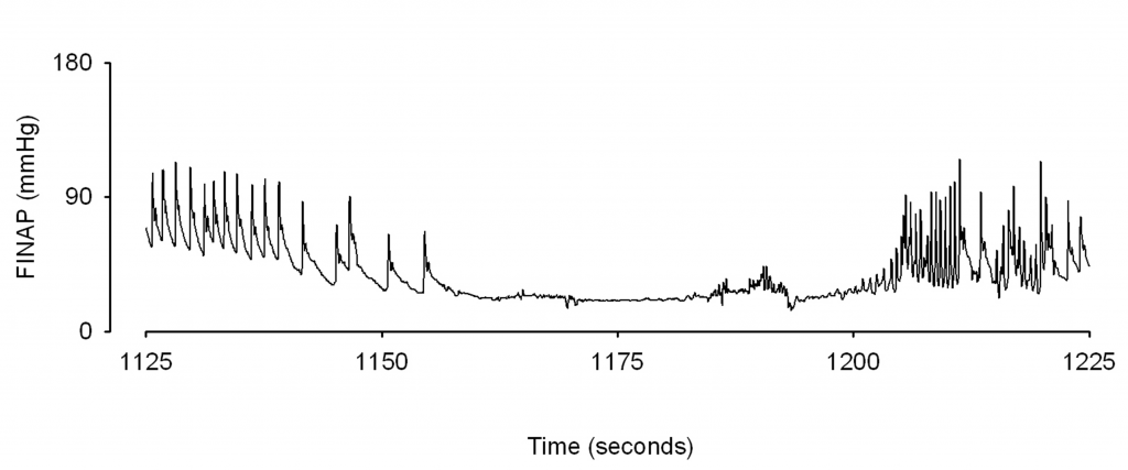 blood pressure during asystole due to blood phobia