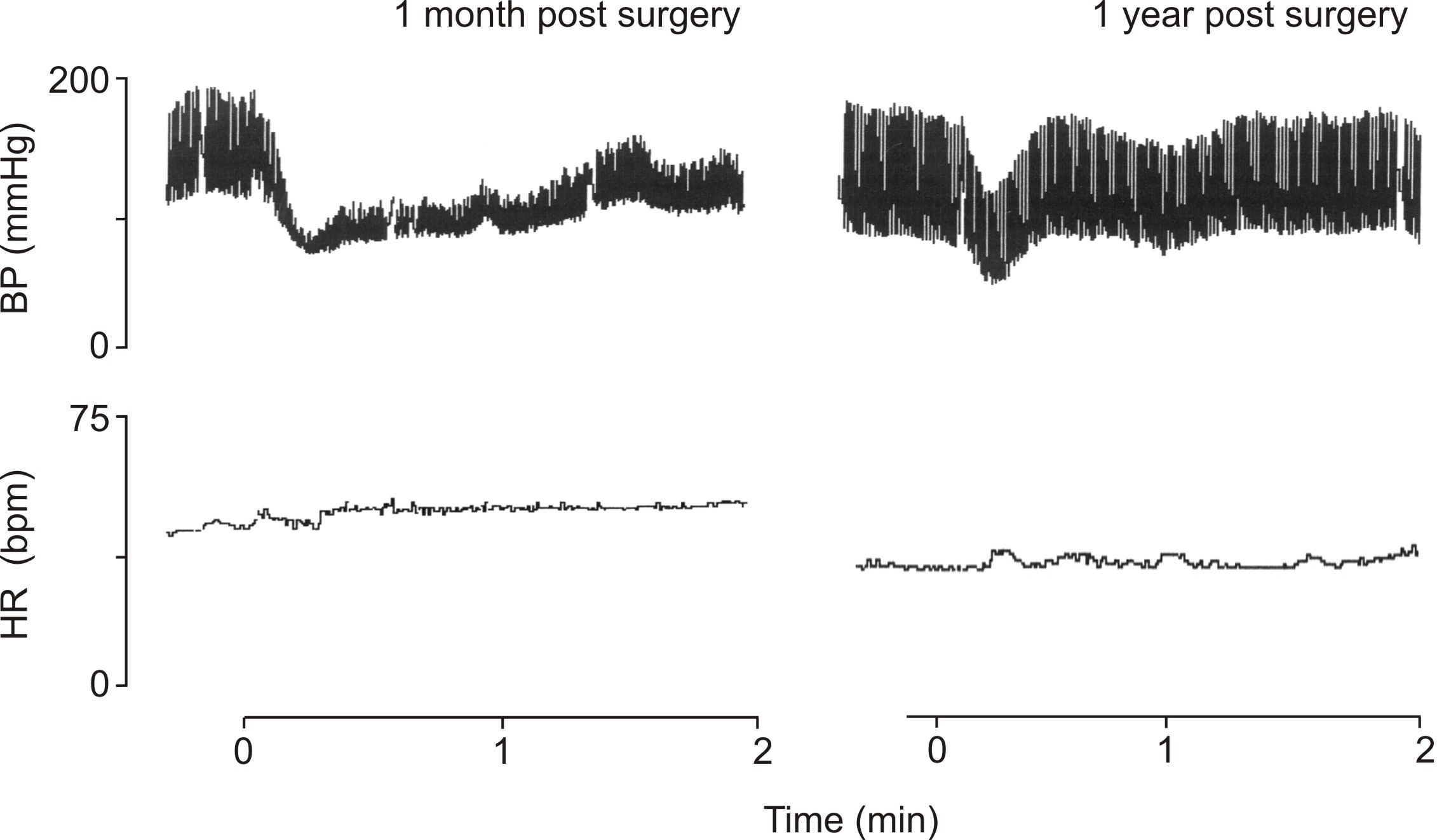 orthostatic hypotension afferent baroreflex failure