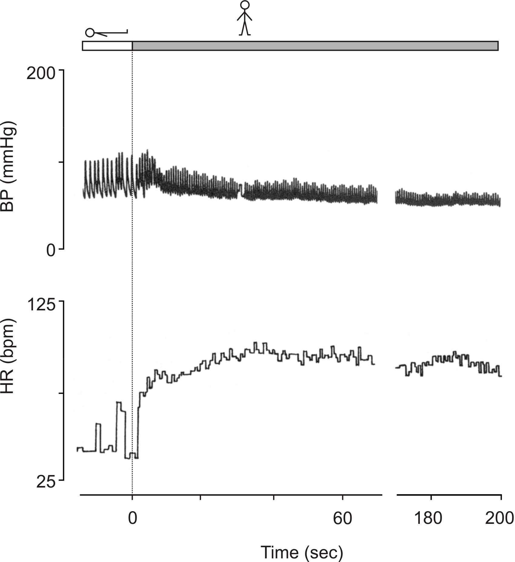 orthostatic hypotension in autonomic failure