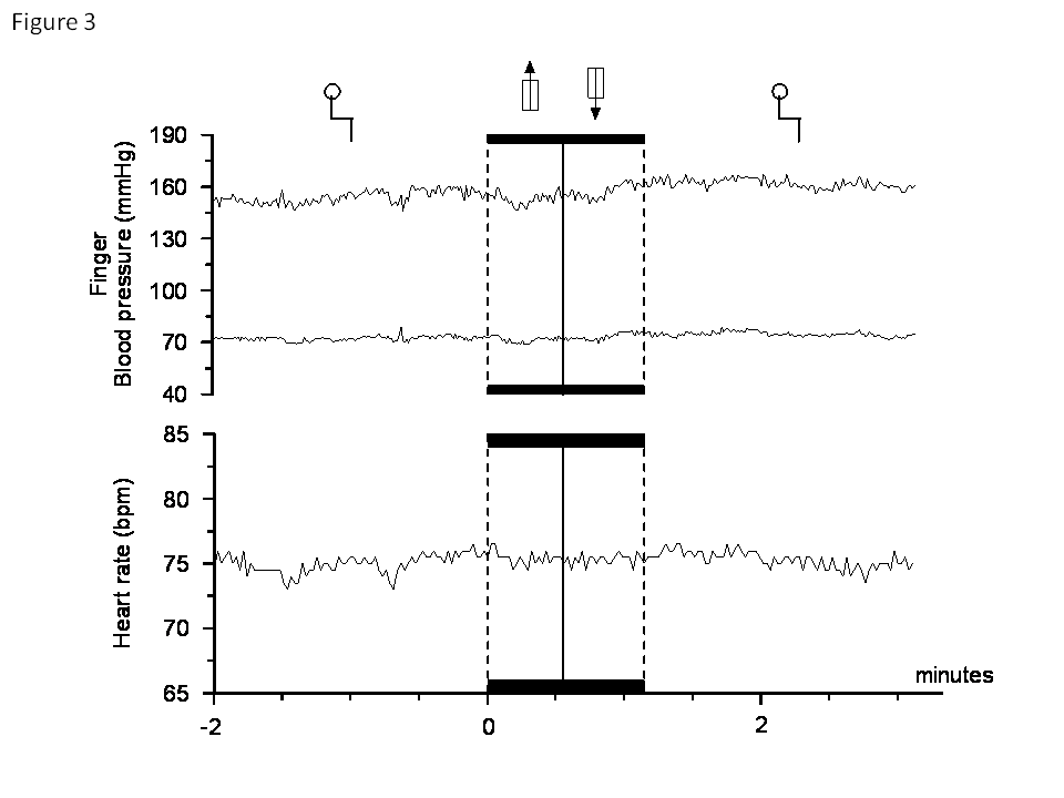 blood pressure elevator autonomic failure