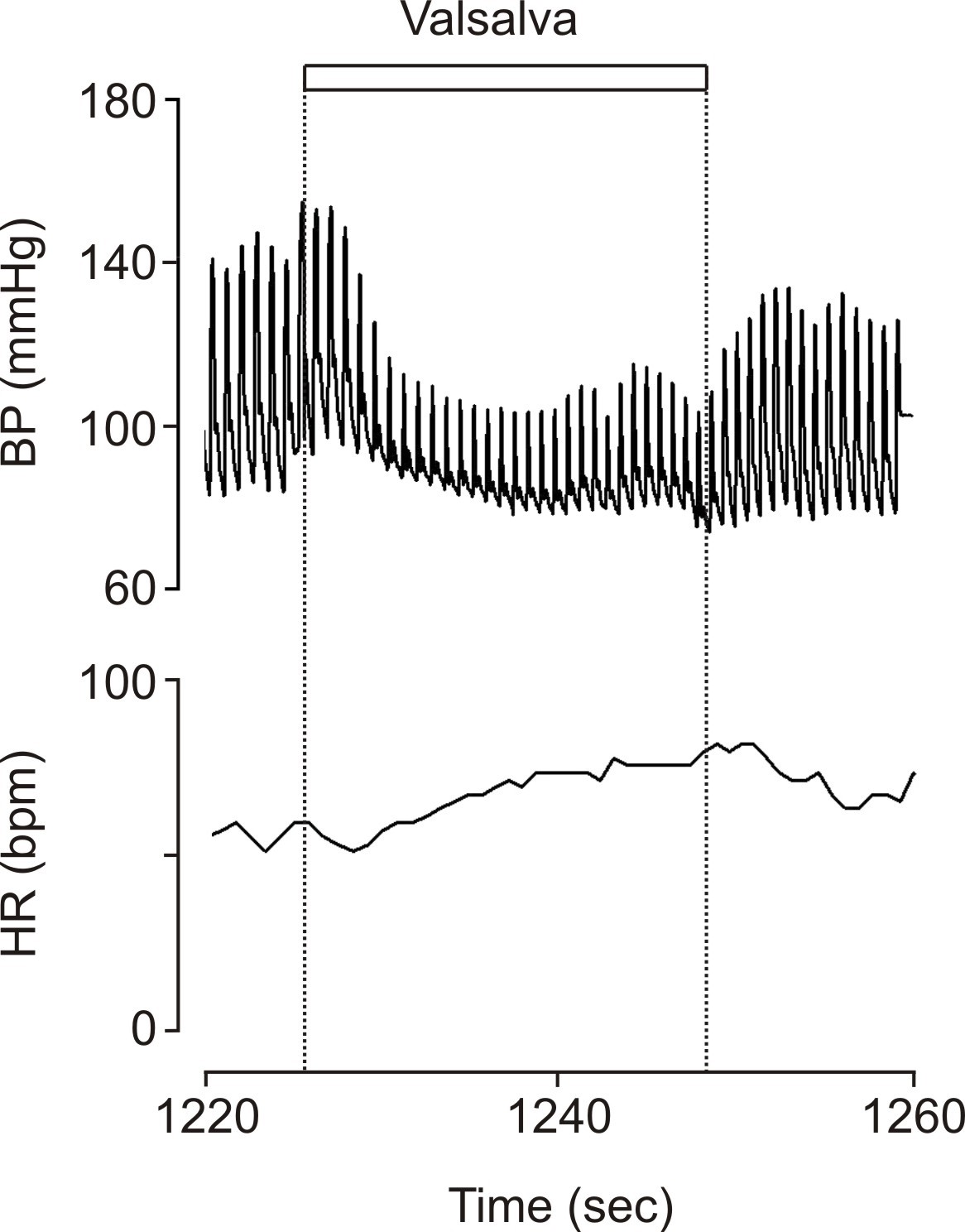 Valsalva manoeuvre blood pressure legionella