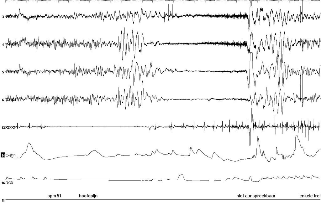EEG during syncope